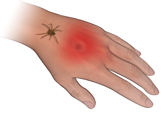 Brown Recluse spider bite