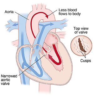 Four-chamber view of heart showing bicuspid aortic valve, with arrows indicating less blood flowing through aortic valve and detail of bicuspid valve.