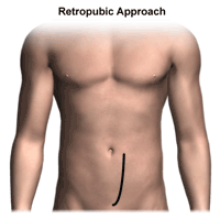 Click Image to Enlarge Illustration of retropubic approach to prostatectomy